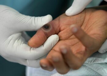 «Алдын алуу чаралары көрүлүп жатат». Министрлик маймыл чечек оорусу боюнча абал туруктуу экенин билдирди