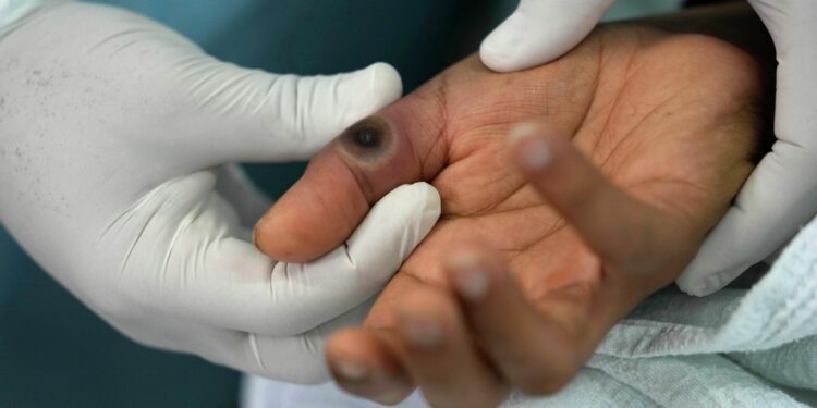 «Алдын алуу чаралары көрүлүп жатат». Министрлик маймыл чечек оорусу боюнча абал туруктуу экенин билдирди