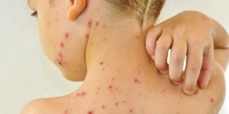 Өлкөдө кызамык илдетинин катталуу учурлары азайып баратат