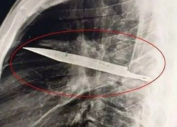 Танзанияда 44 жаштагы киши 8 жыл бою көкүрөгүнө сайылган бычак менен жүргөн