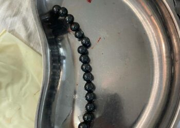 Ошто 17 магнит жутуп алган  2 жаштагы балага ийгиликтүү операция  жасалды