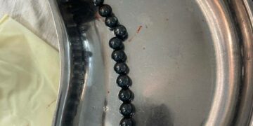 Ошто 17 магнит жутуп алган  2 жаштагы балага ийгиликтүү операция  жасалды