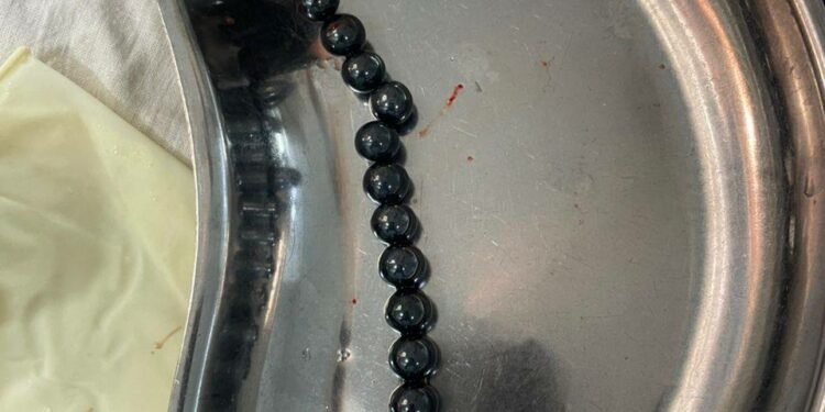 Ошто 17 магнит жутуп алган  2 жаштагы балага ийгиликтүү операция  жасалды